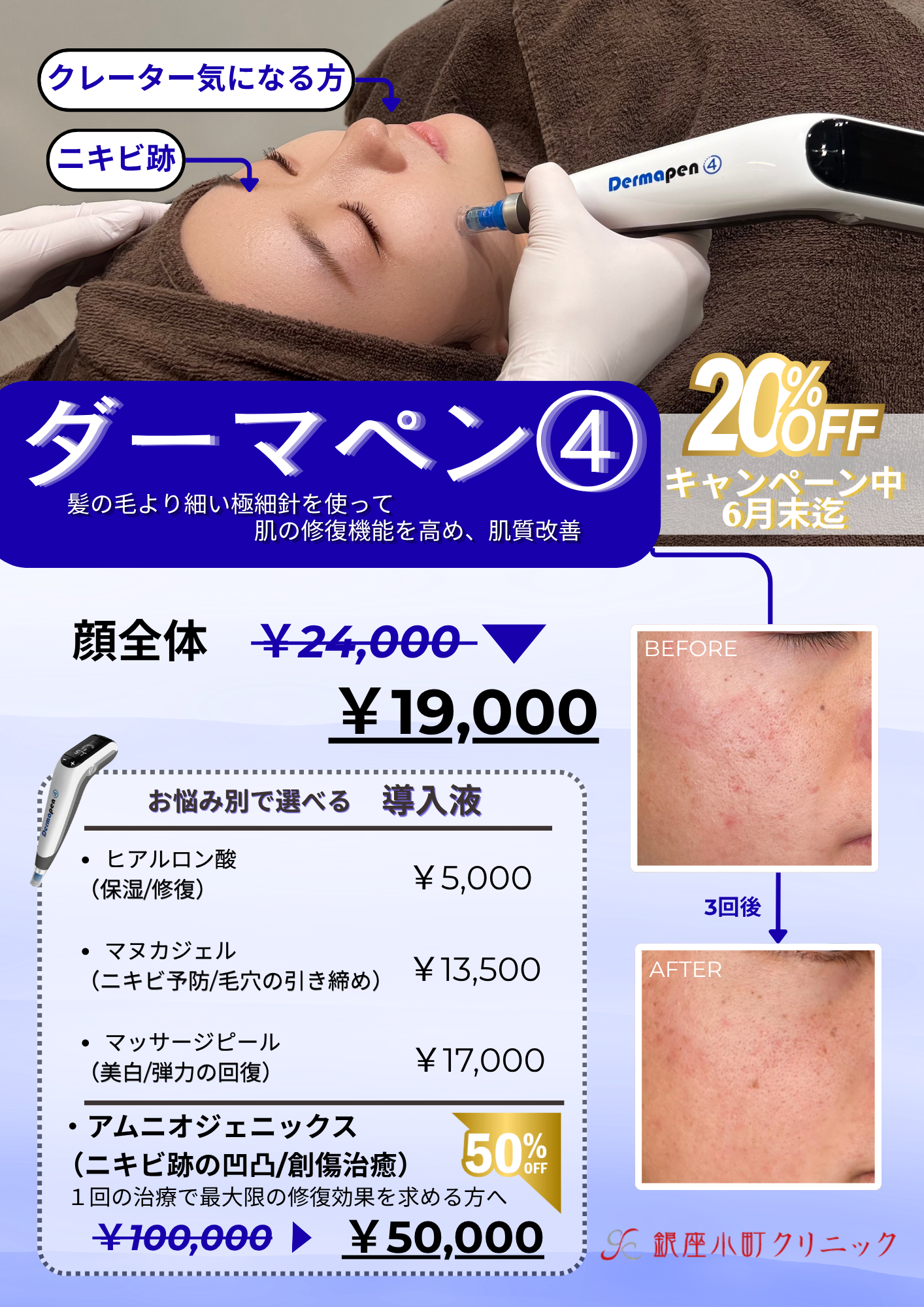 ダーマペン　20％OFFキャンペーン！
